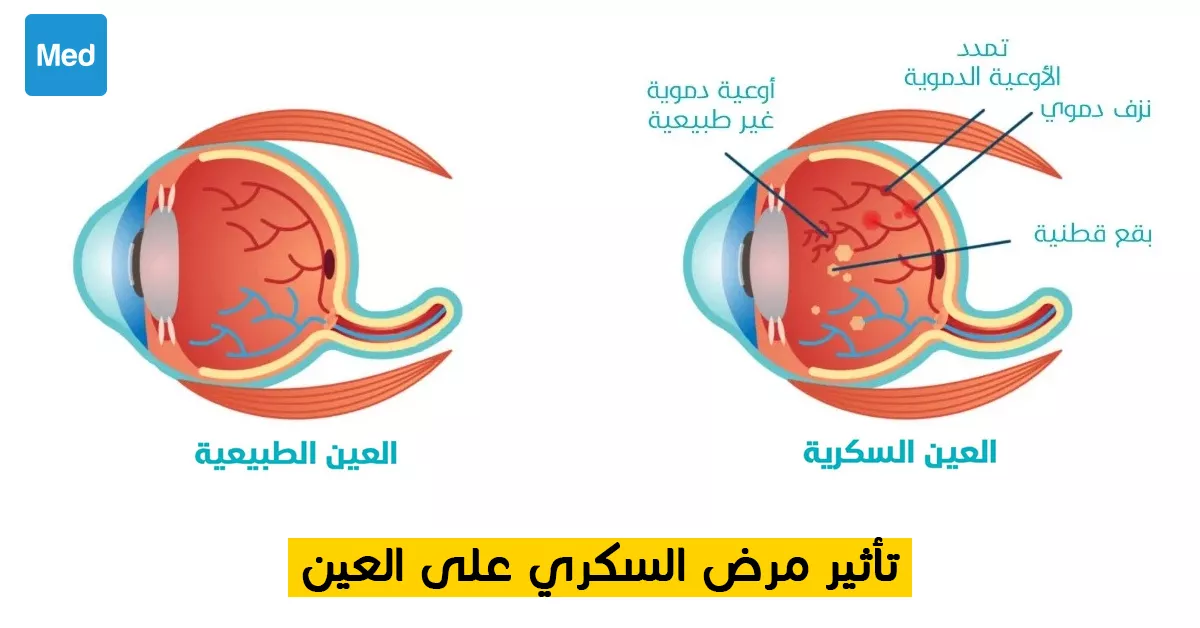 تأثير مرض السكري على العين